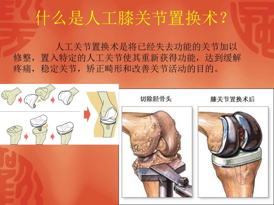 人工膝关节置换的护理查房课件_第3页