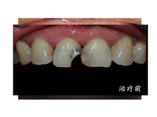 上颌中切牙课件