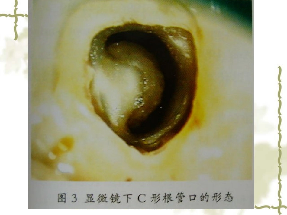 上下颌磨牙的髓腔形态及乳牙髓腔形态第二部分_第3页