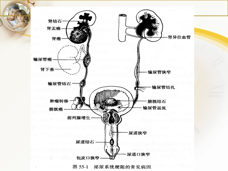 肾积水的护理课件_第3页