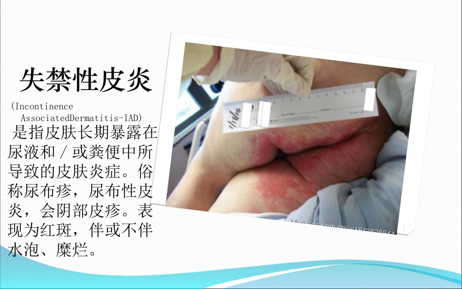 失禁性皮炎和压疮的区别最终版_第3页