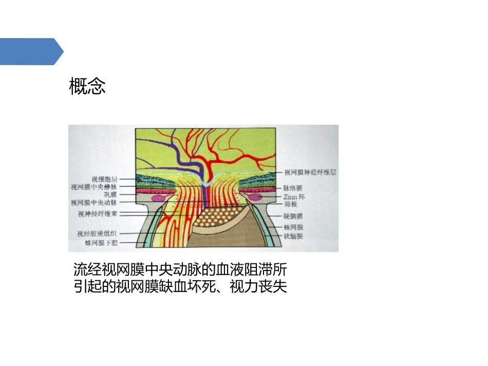 视网膜中央动脉阻塞课件_第2页