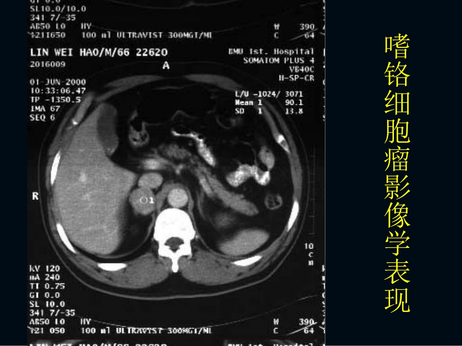 嗜铬细胞瘤术后护理_第3页