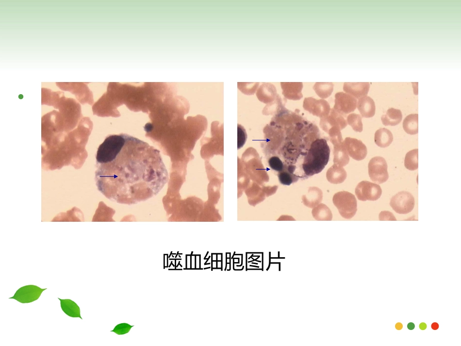 噬血细胞综合征HPS_第3页