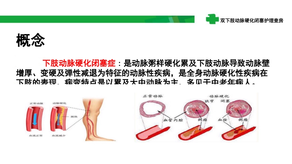 双下肢动脉硬化闭塞护理查房_第3页