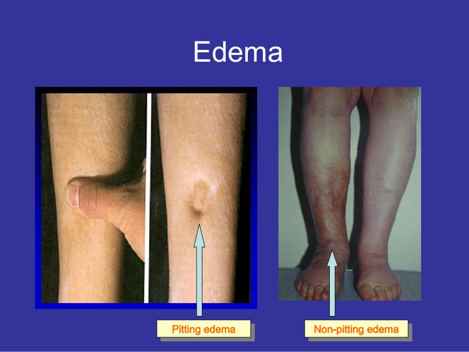 水肿EDEMA_第3页