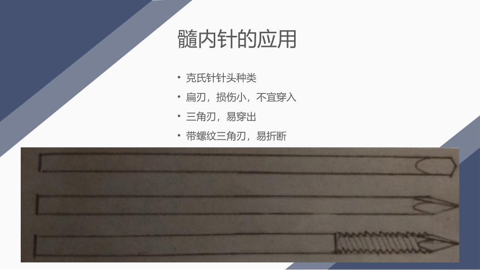 髓内针的应用_第3页