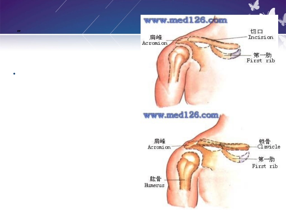 锁骨骨折切开内固定除术护理查房_第2页