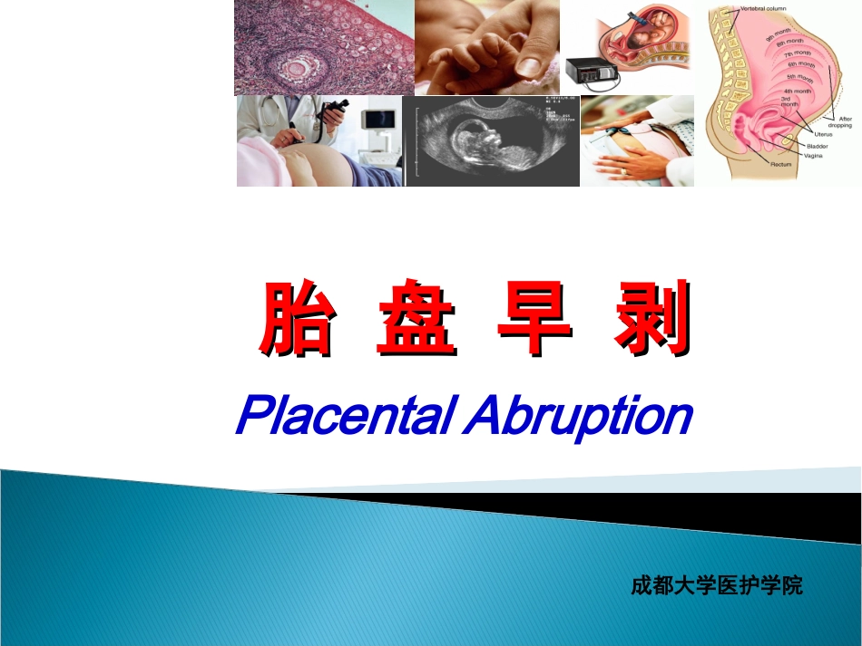 胎盘早剥CLL_第2页
