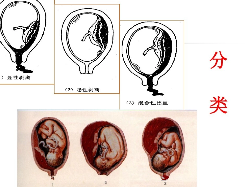 胎盘早剥的护理课件_第3页