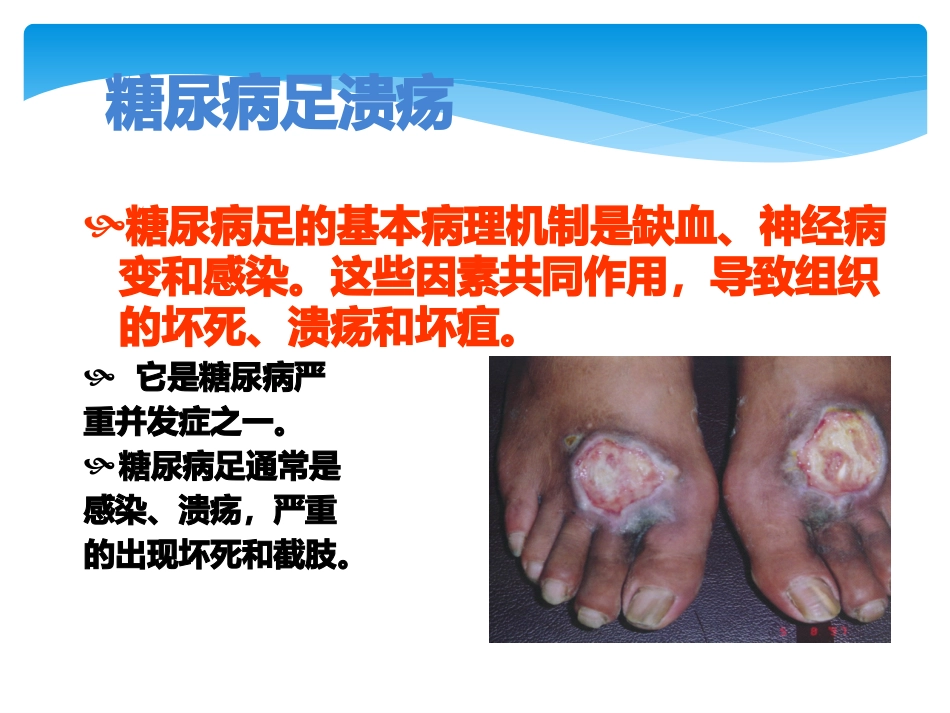 糖尿病足溃疡_第2页