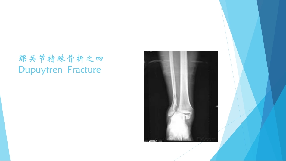 特殊类型的踝关节骨折_第2页