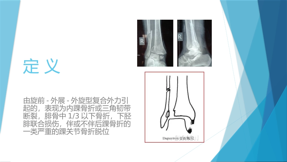 特殊类型的踝关节骨折下_第3页