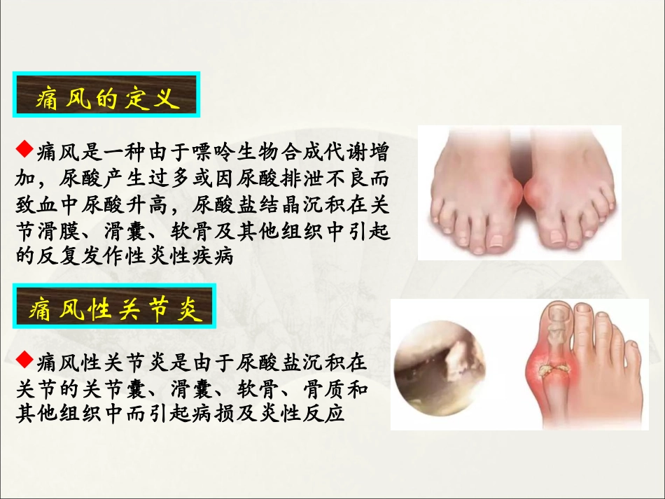 痛风性关节炎的中西医结合诊疗课件_第2页