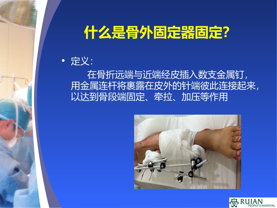 外固定架治疗胫腓骨骨折的临床观察和护理创新教材_第2页