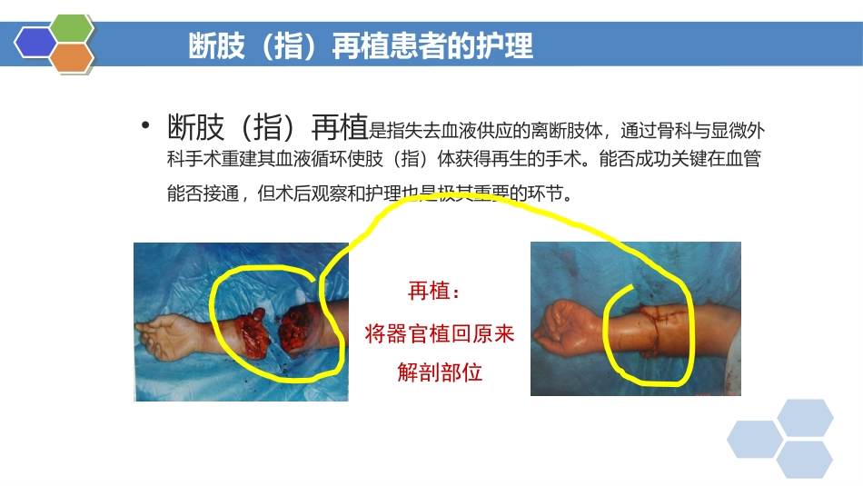 外科护理断肢指再植患者的护理_第2页