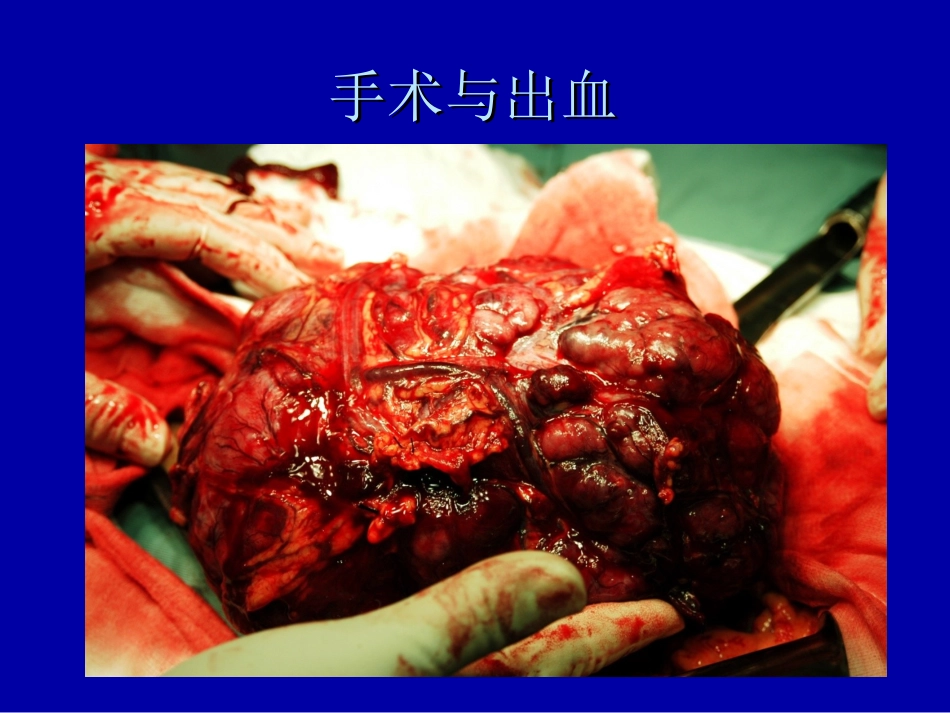 外科手术出血_第2页