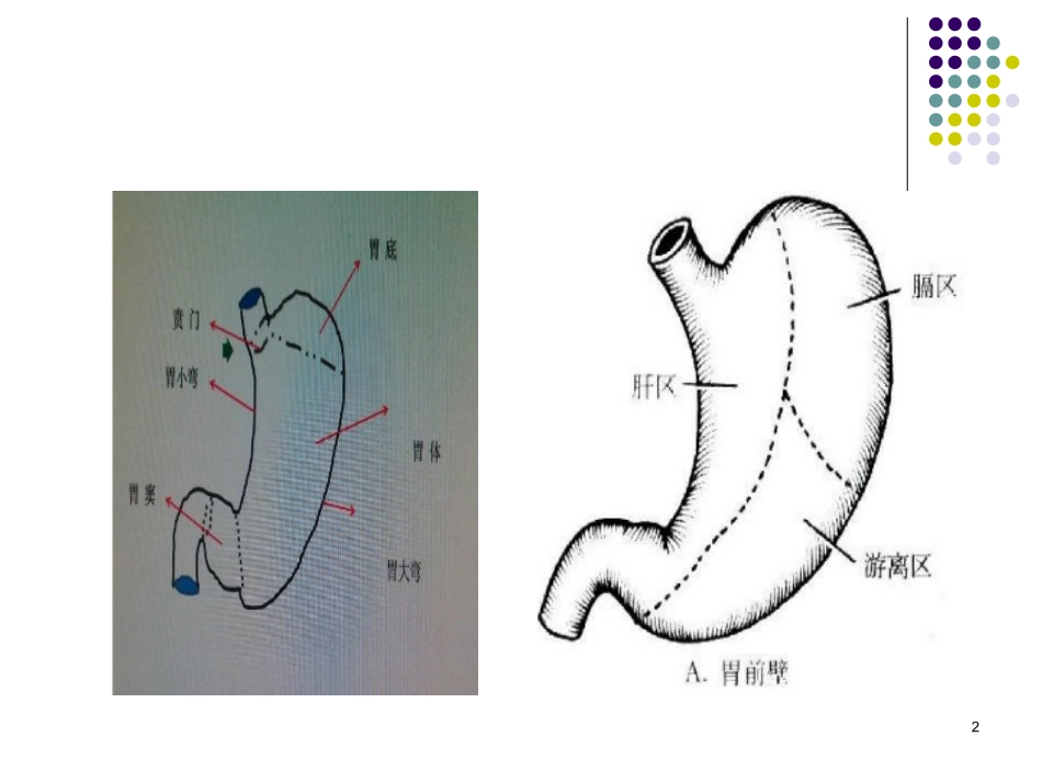 胃大部分切除术手术配合课件_第2页