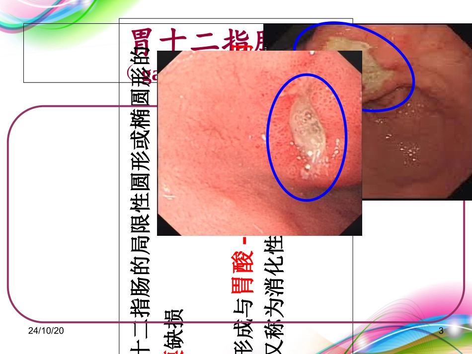 胃十二指肠溃疡患者的护理_第3页