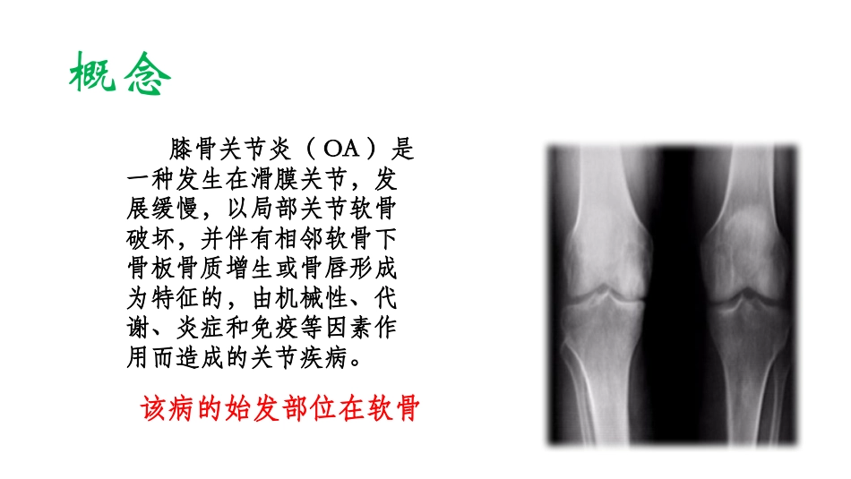 膝关节骨性关节炎诊治_第2页