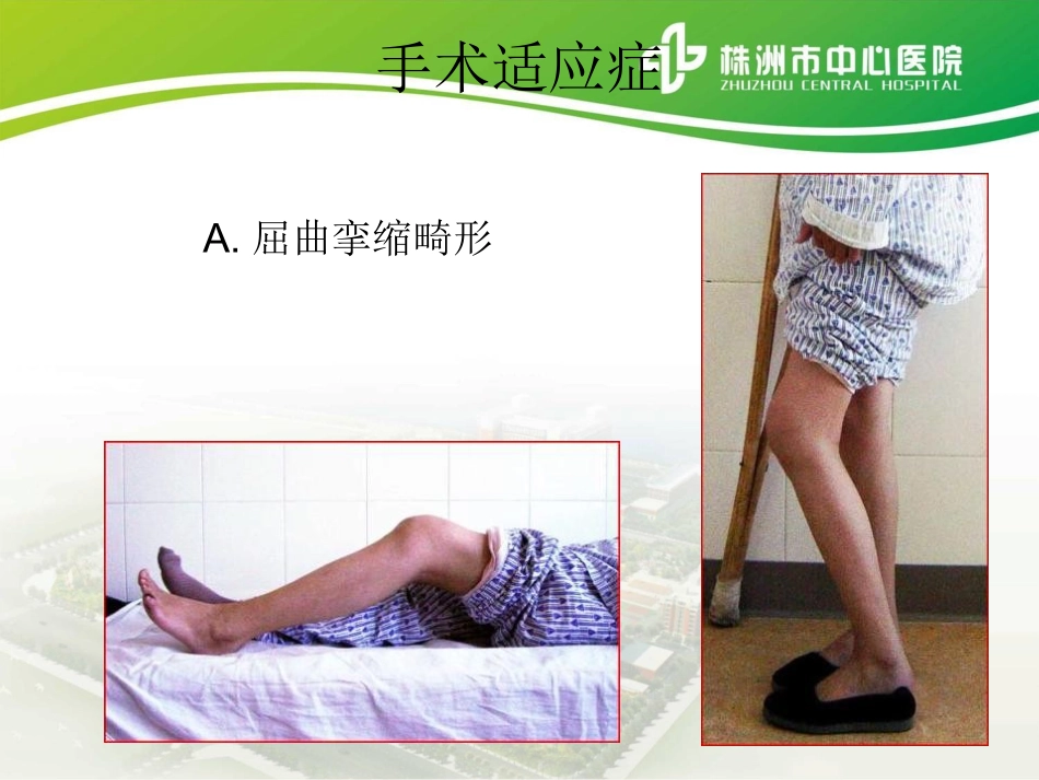 膝关节置换术后护理_第3页