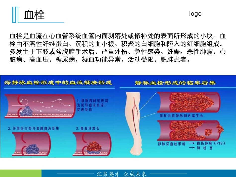 下肢深静脉血栓的预防及护理_第2页