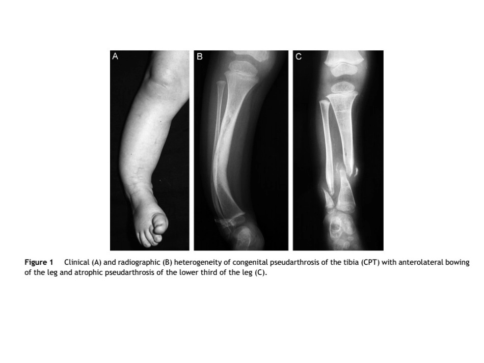 先天性胫骨假关节课件_第1页