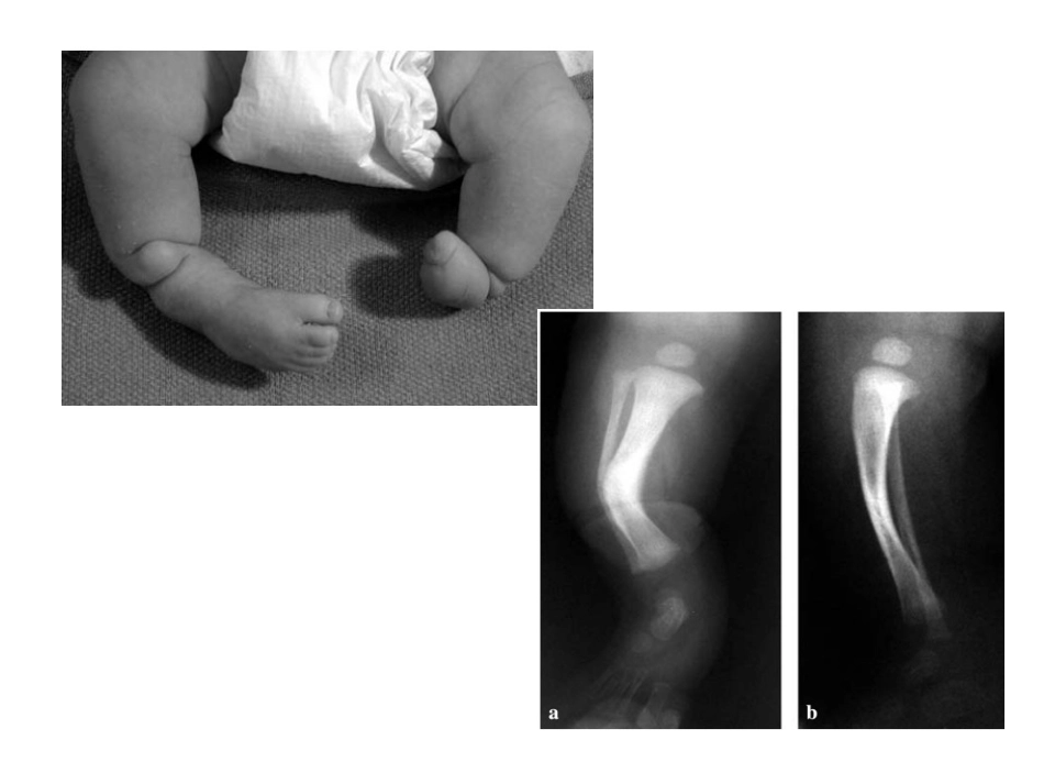 先天性胫骨假关节课件_第3页