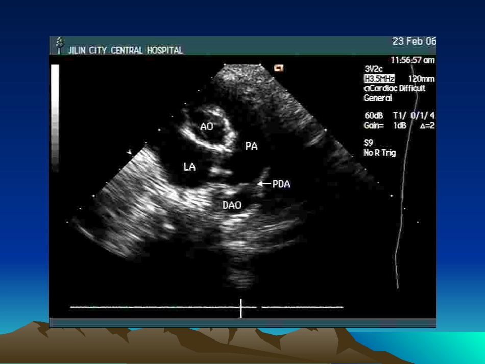 先心病介入治疗PDA_第3页
