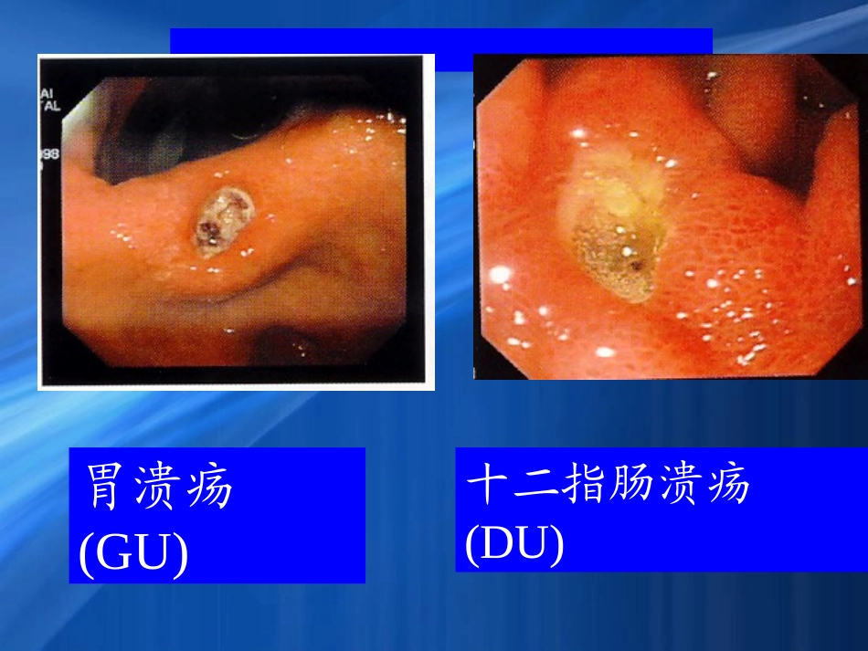 消化性溃疡科内小讲课_第3页