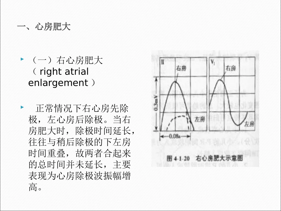 心电图心房肥大与心室肥大_第3页