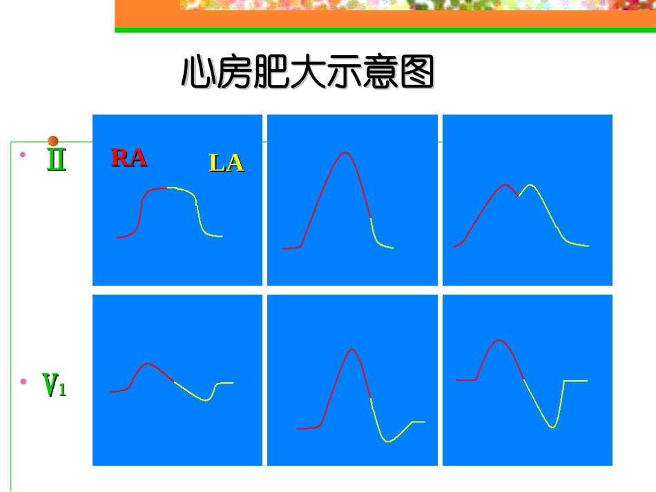 心房与心室肥大_第3页