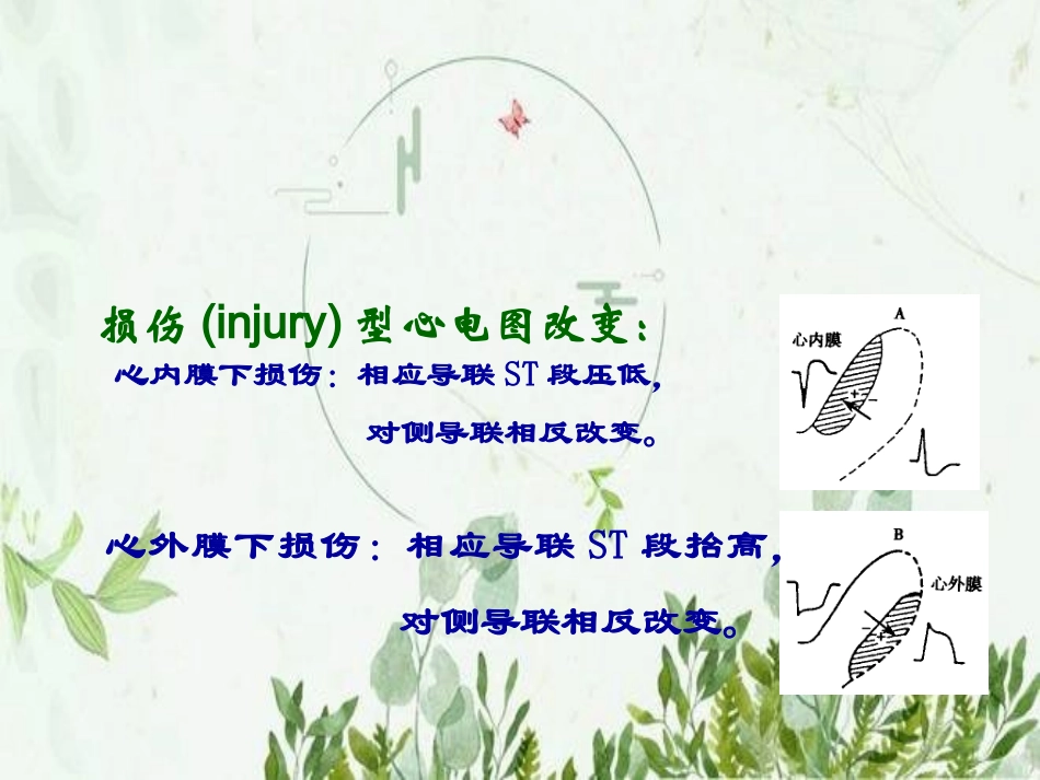 心肌缺血心电图图文_第2页
