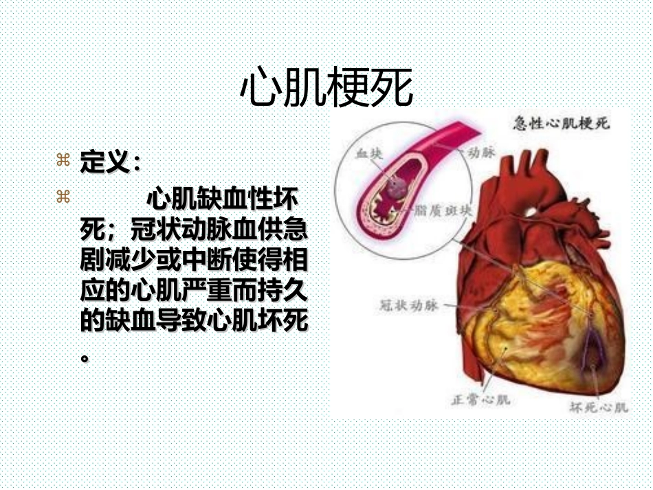 心绞痛和心肌梗死的护理_第2页
