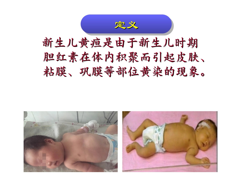 新生儿黄疸护理及健康教育课件_第2页