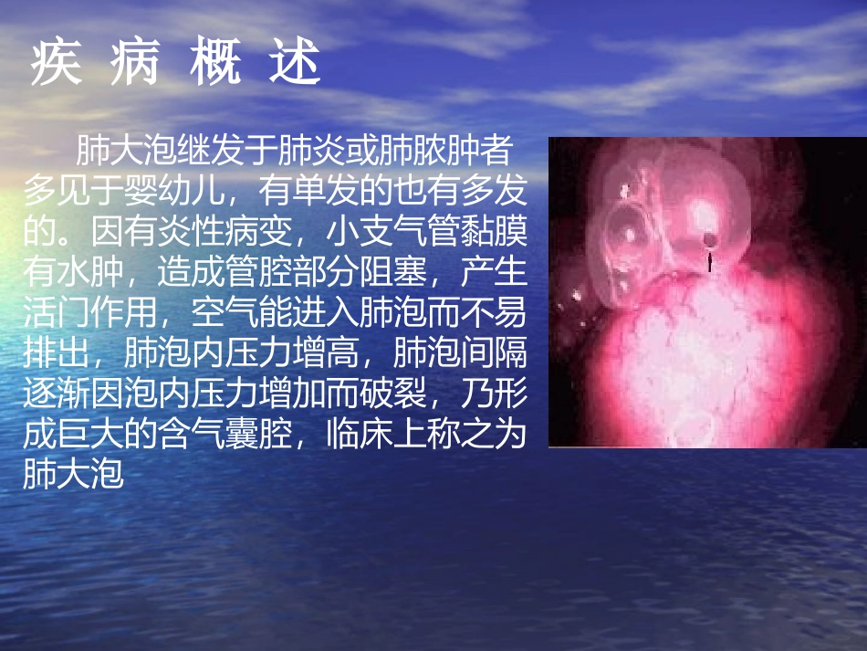 胸腔镜肺大疱切除讲义_第3页