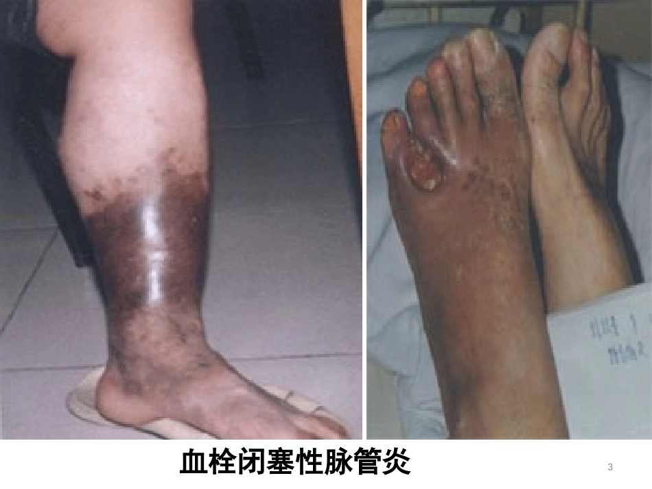 血栓闭塞性脉管炎病人的护理要点_第3页