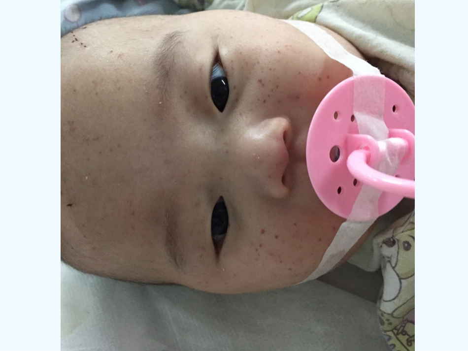 血小板减少性紫癜查房_第3页