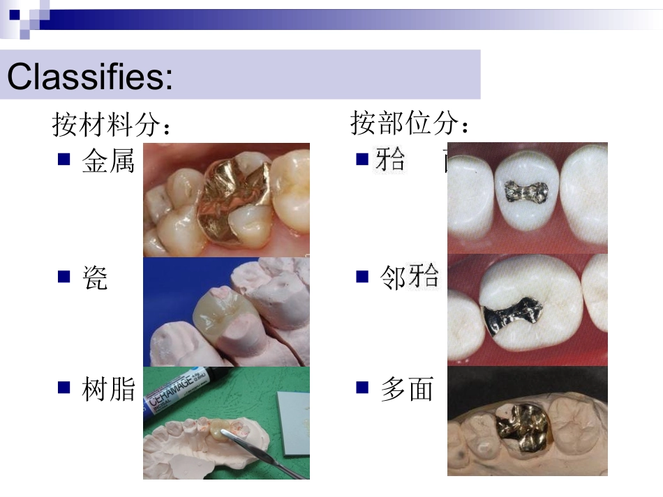 牙体缺损的修复嵌体_第3页