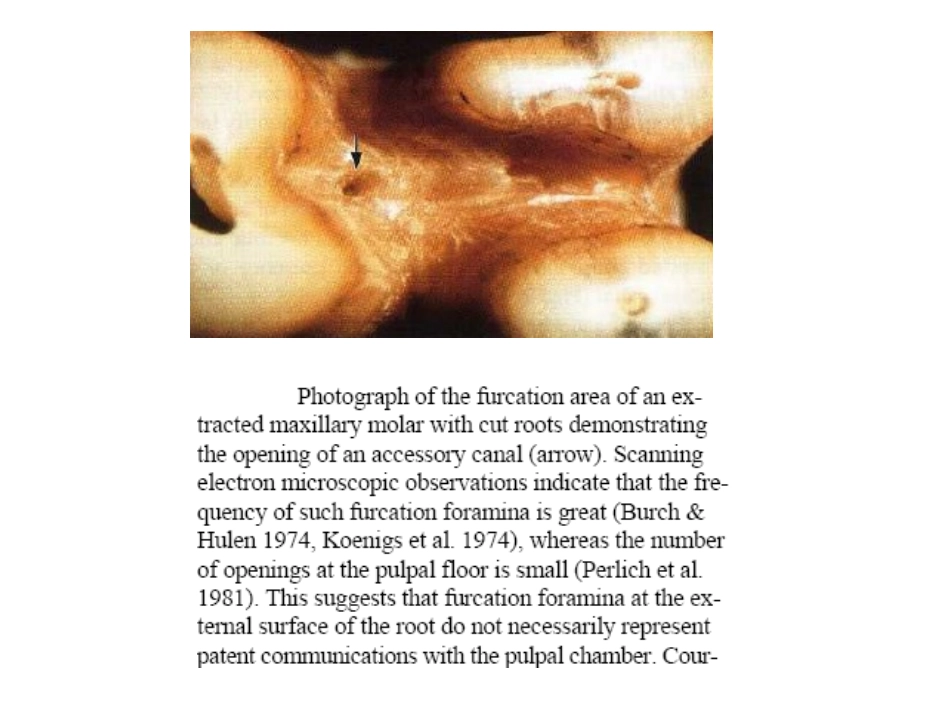 牙周牙髓联合病变课件_第3页