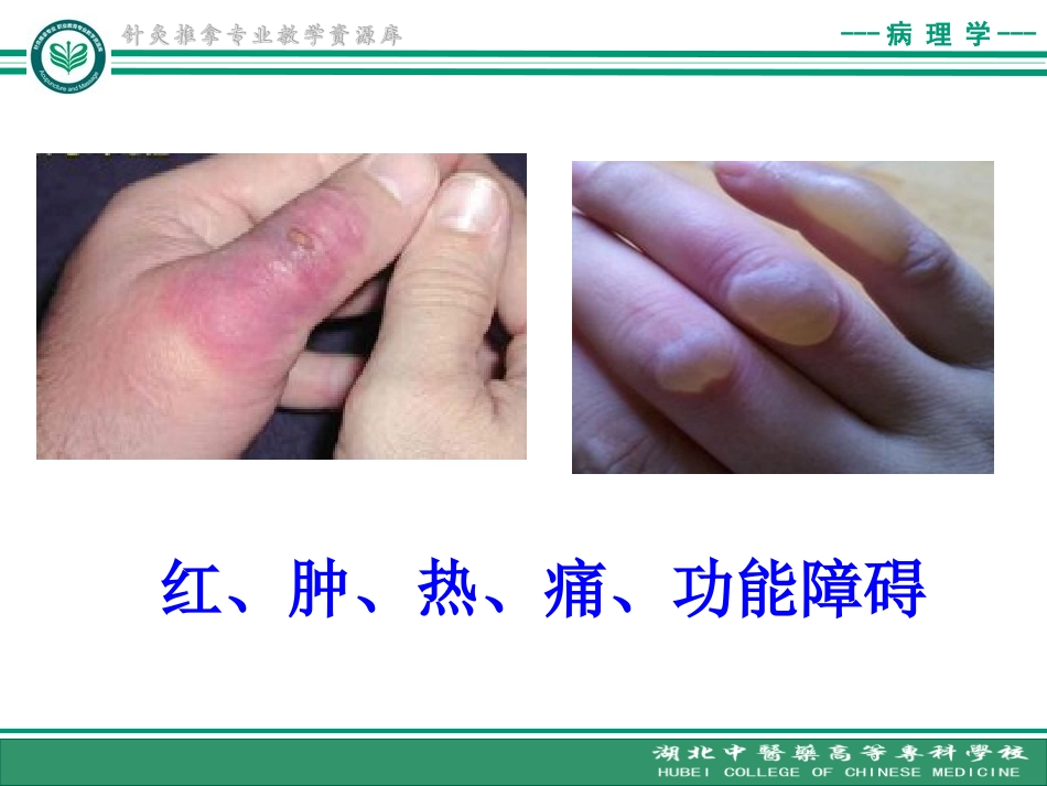 炎症的定义原因及炎症介质精_第3页