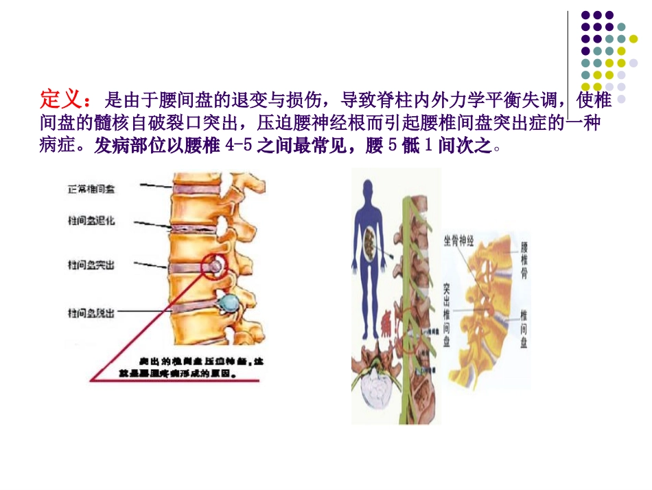 腰间盘突出症精讲_第2页