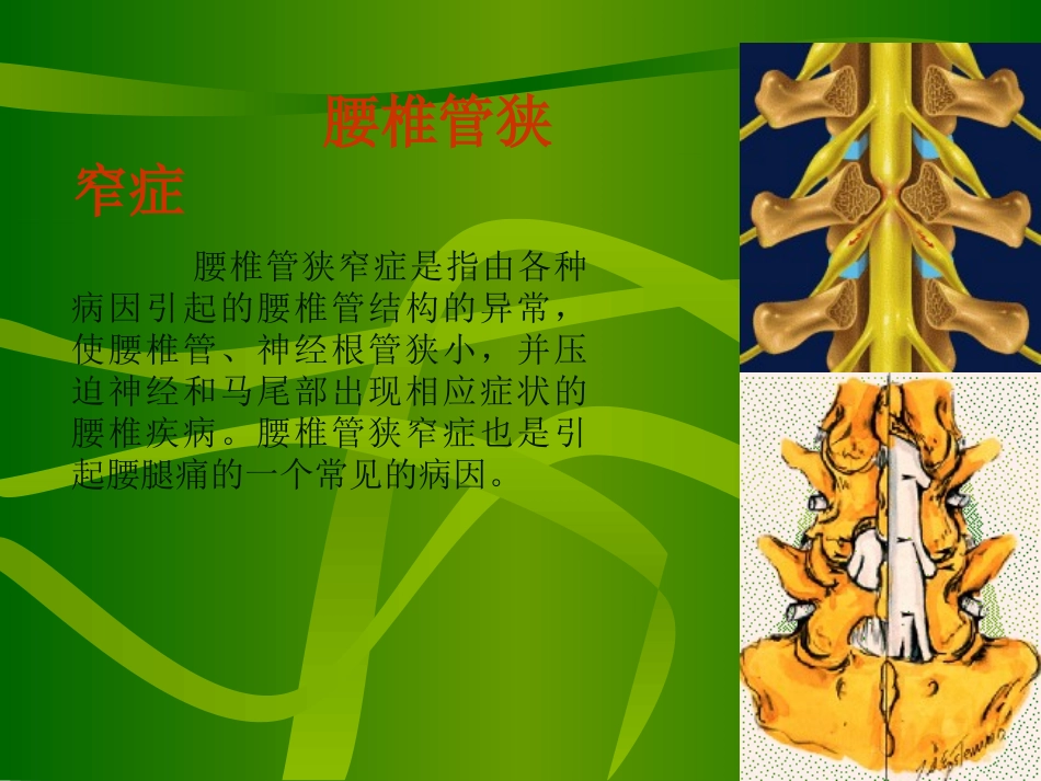 腰椎管狭窄症分析_第1页