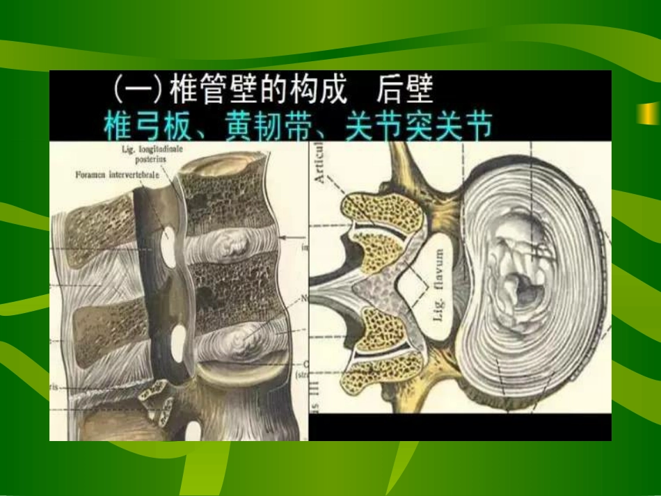 腰椎管狭窄症分析_第3页