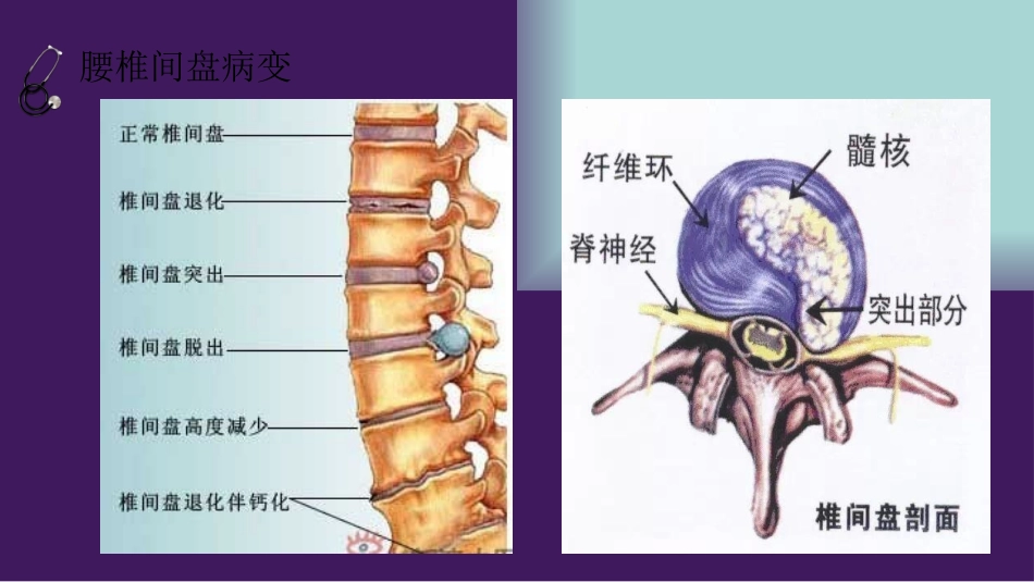 腰椎间盘突出症健康教育_第3页