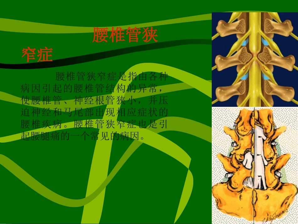 腰椎椎管狭窄症_第1页