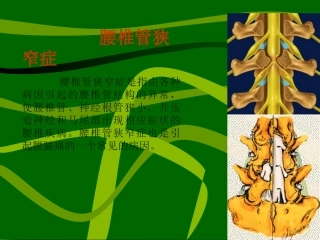 腰椎椎管狭窄症