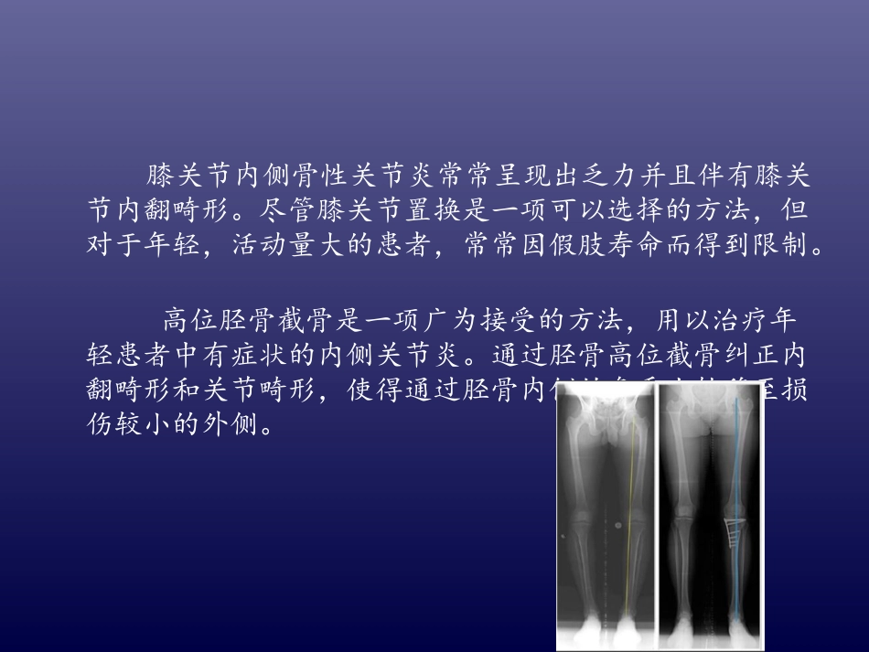 伊里扎洛夫技术技术结合胫骨高位截骨治疗骨性关节炎_第2页