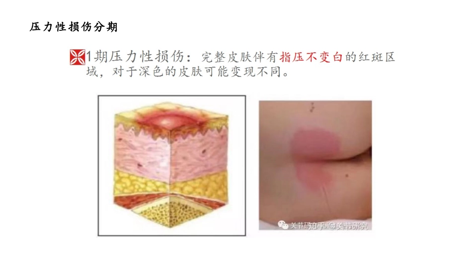 医疗器械压力性损伤_第3页