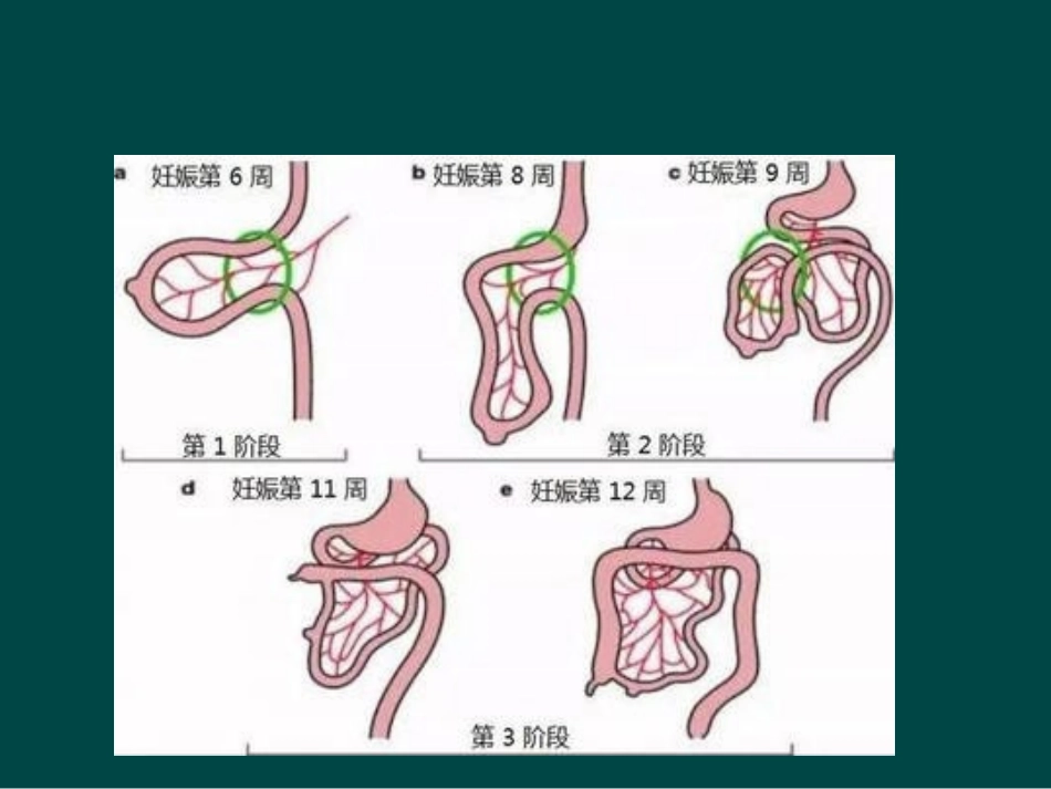 医学课件先天性肠旋转不良的临床特点及各种影像诊断方式价值探讨_第1页